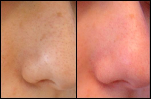 antes e depois da limpeza no nariz