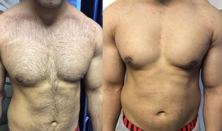 antes e depois da depilação do peito