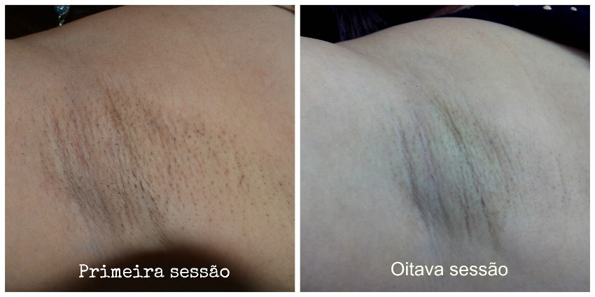 procedimento de depilação antes e depois