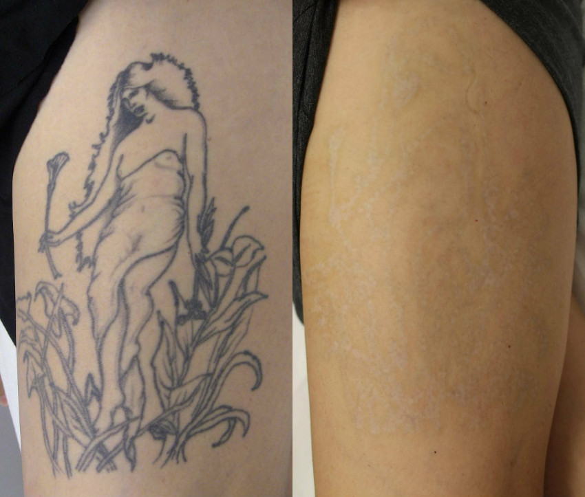 antes e depois - remoção de tatuagem