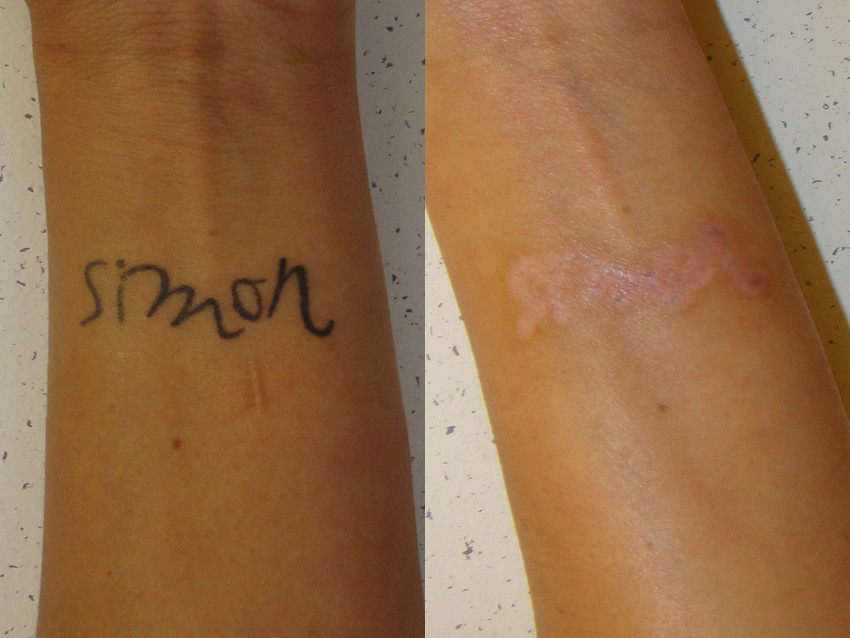 remoção de tattoo com laser antes e depois