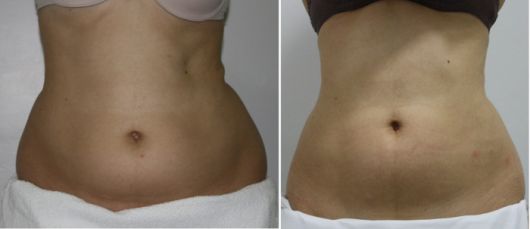 Lipocavitação: Funciona? 20 Fotos antes e depois!