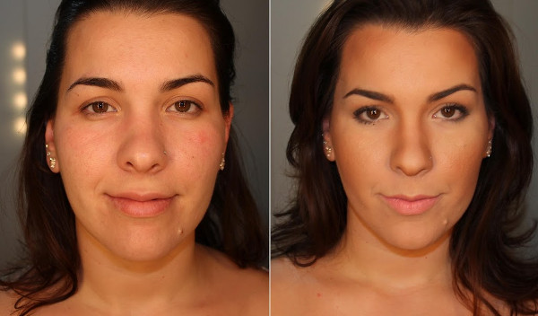 Imagens antes e depois do preenchimento facial