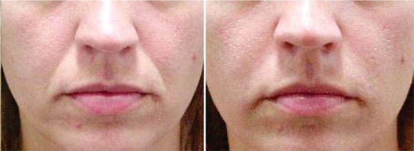 Processo de preenchimento de bigode antes e depois