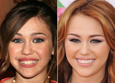 miley antes e depois da lente dental