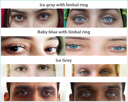 cirurgia para mudar a cor dos olhos antes e depois