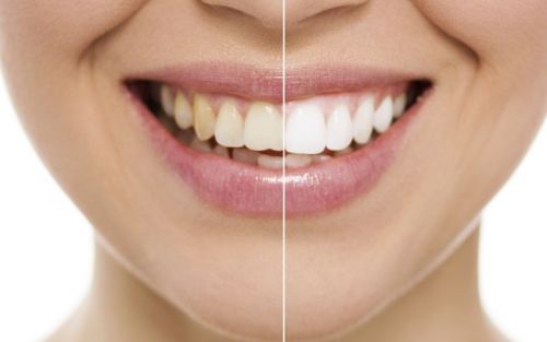 clareamento dos dentes