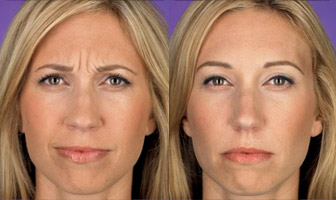 antes e depois do botox