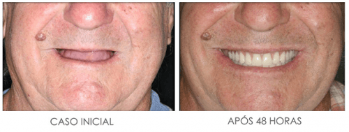 antes e depois do implante
