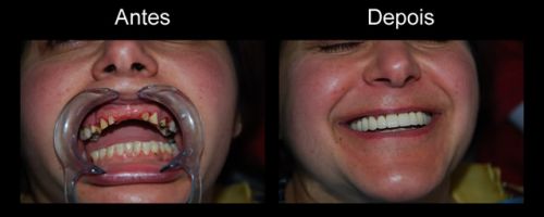 como fazer implante dentário