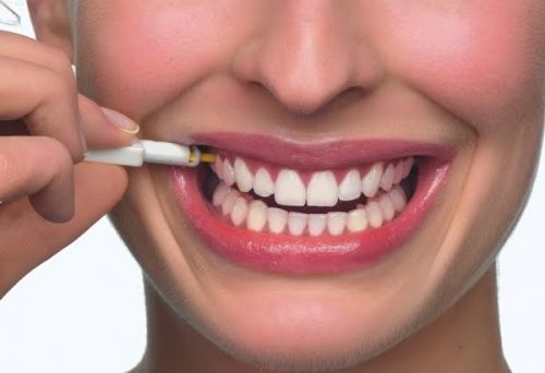 dentes lindos após o implante