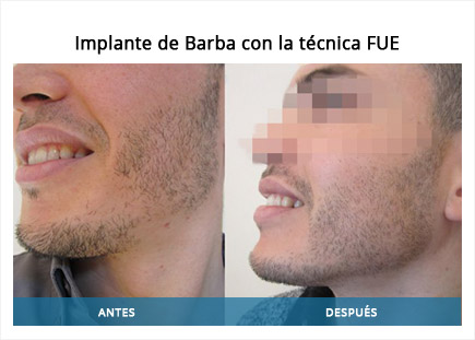 implante de barba famosos
