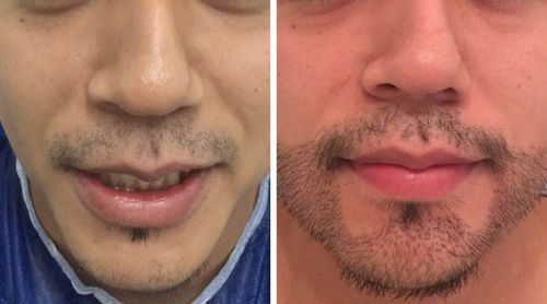 implante de barba preço valor