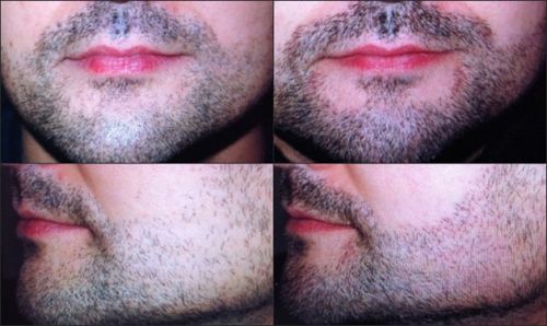 implante de barba preço
