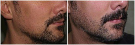 implante de barba