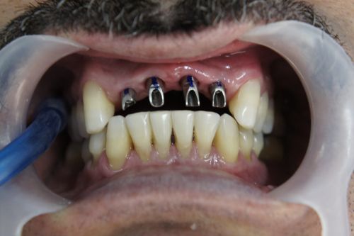 implante dentario recuperação