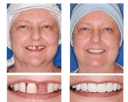 implante dentário antes e depois resultados