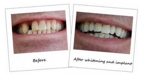 implante dentário antes e depois