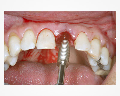 implante dentário como é feito