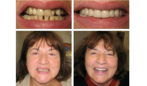 implante dentário resultados