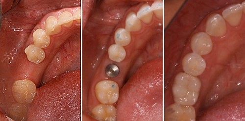 raiz de titanio implante dentário