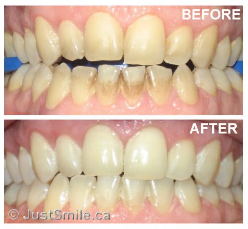 clareamento dental a laser antes e depois