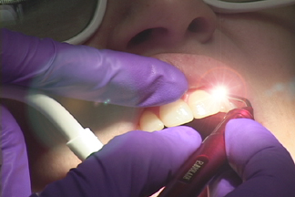 clareamento dental a laser o que é como é feita