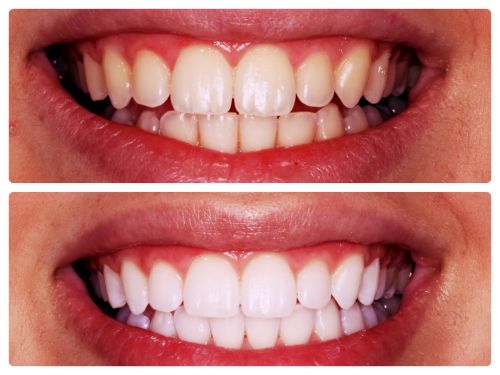 clareamento dental antes e depois